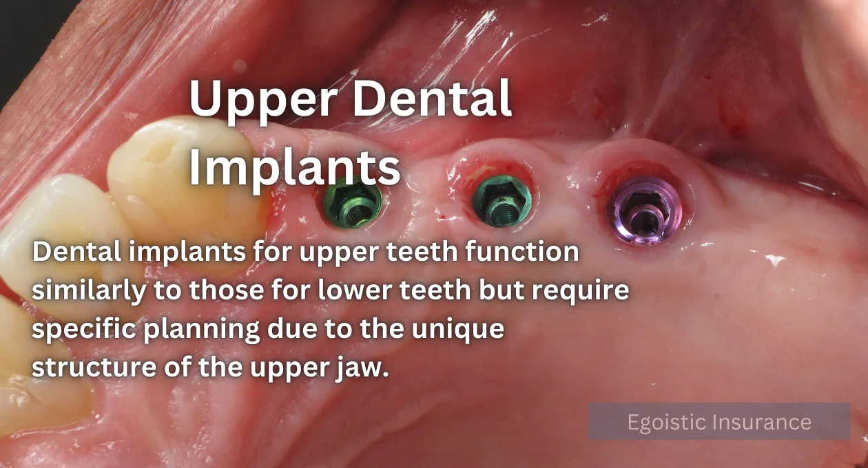 upper dental implants