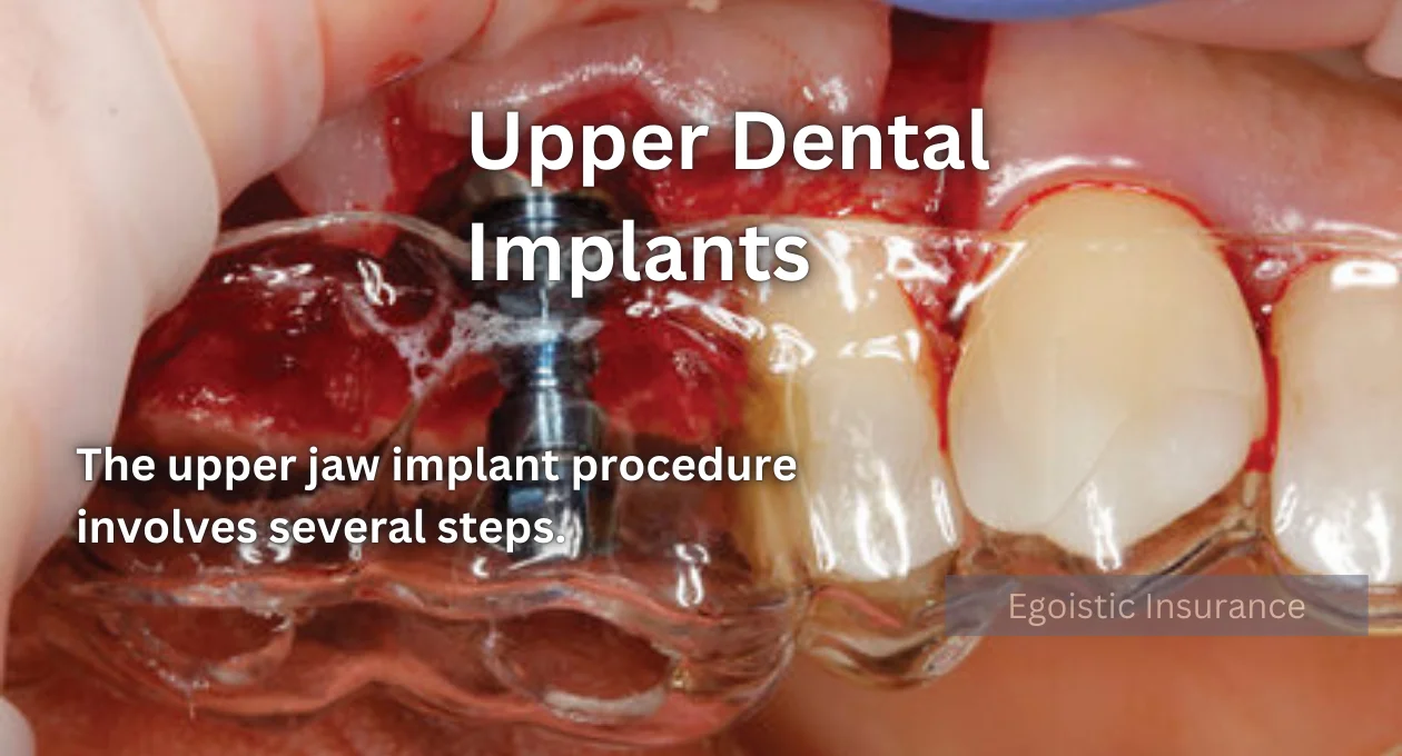 upper dental implants