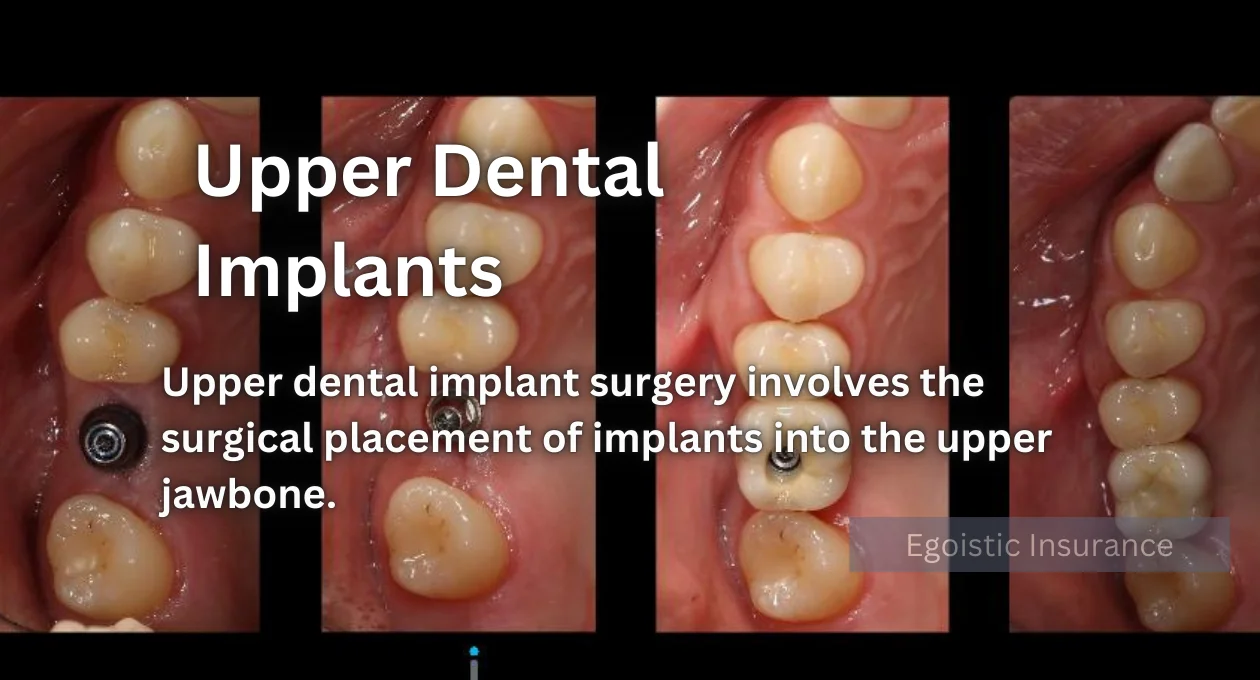 upper dental implants